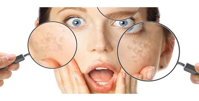 Macchie cutanee: cosa sono e come prevenirle